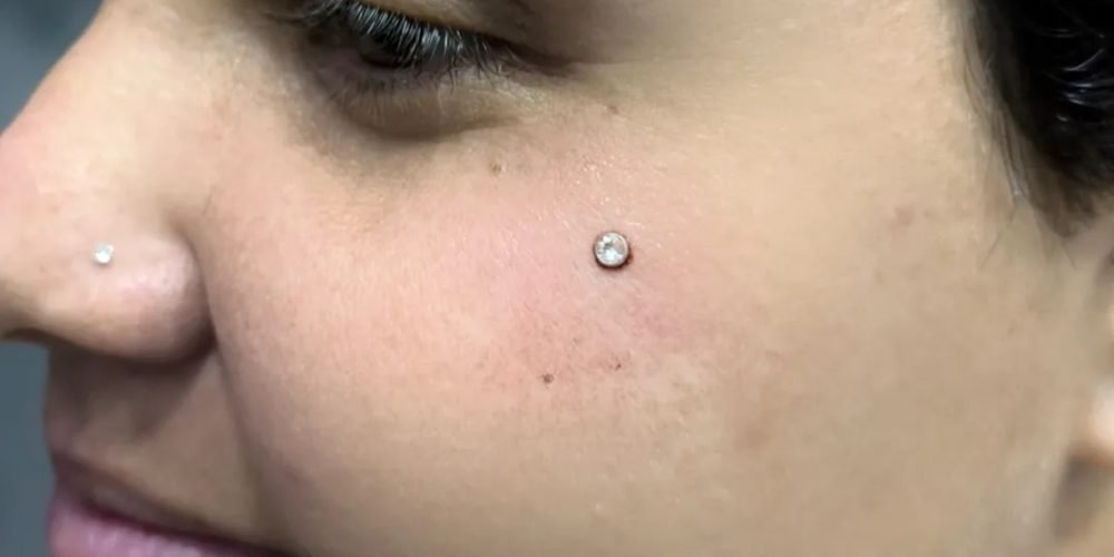 IMPLANTE MIDRODERMAL EM SANTA ISABEL - KINGS TATTOO